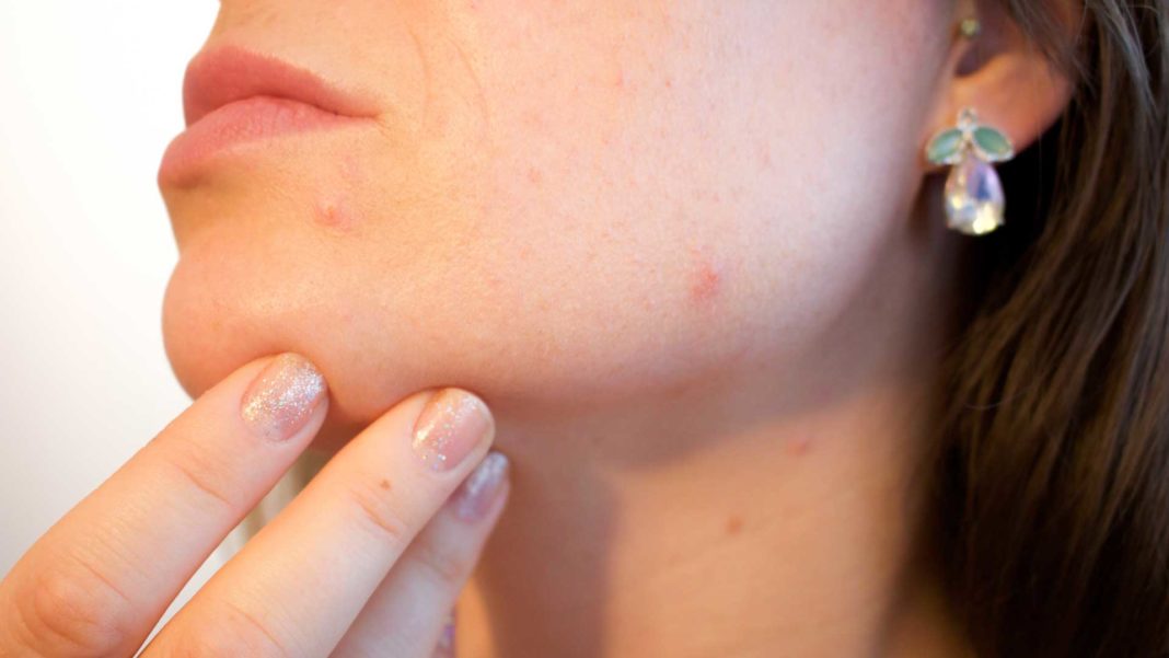 Stop-Believing-Three-Myths-about-Acne-Right-Now--on-SelfGrowth